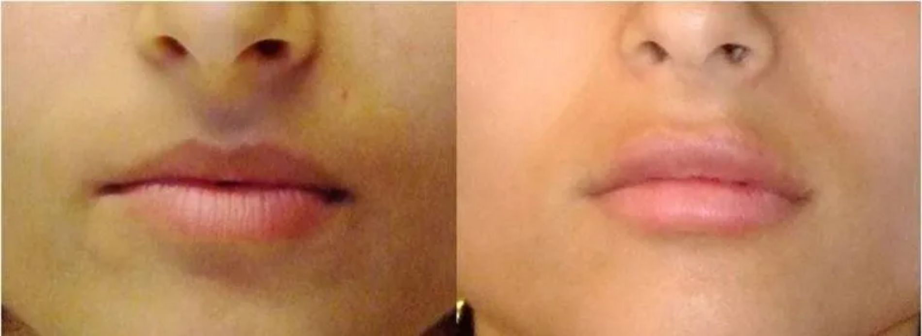 riduzione delle rughe del viso