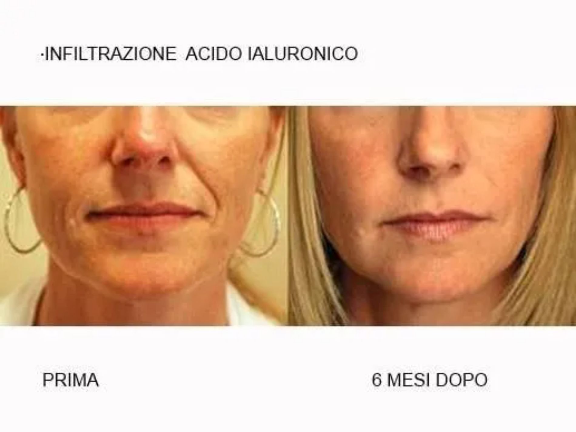 prima e dopo infiltrazione di acido ialuronico
