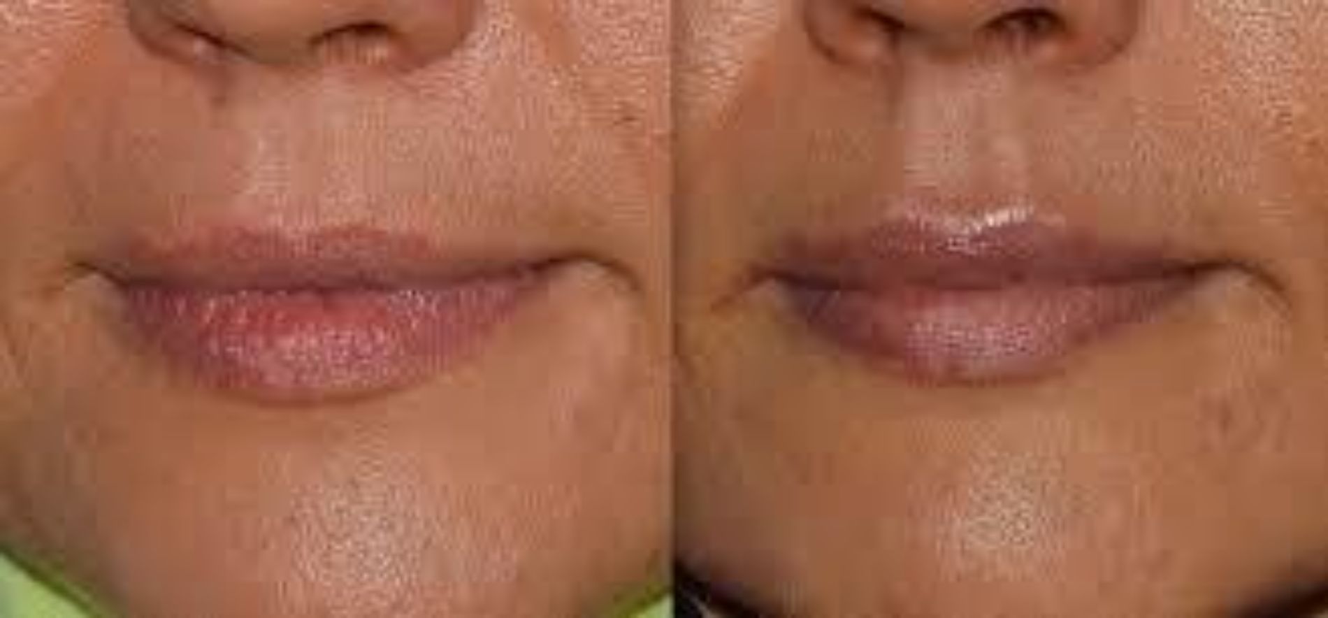 prima e dopo cura estetica delle rughe