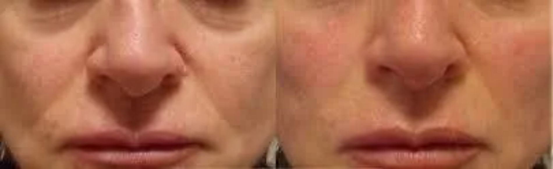 risultato cura estetica delle rughe