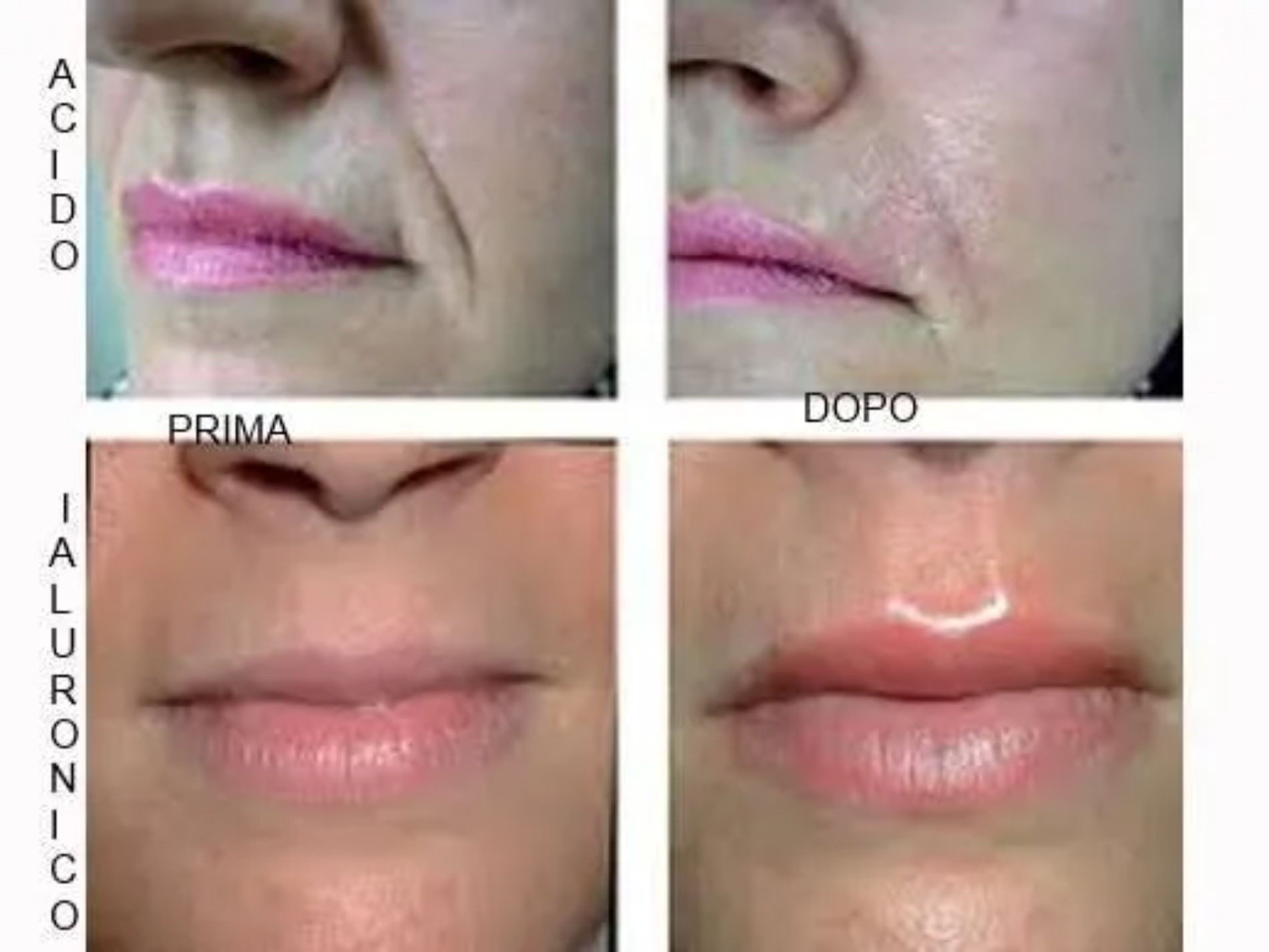 prima e dopo acido ialuronico