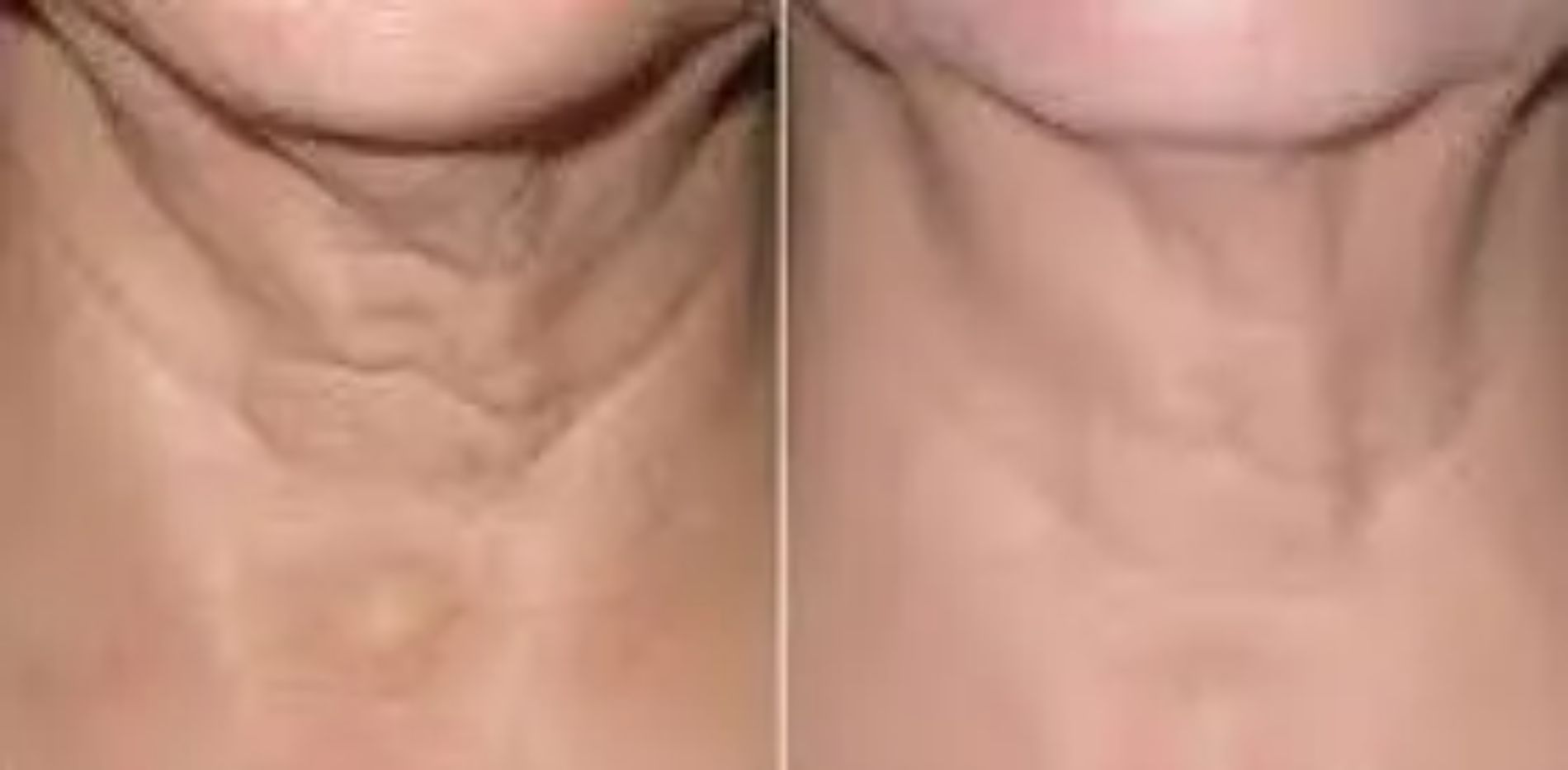 riduzione rughe del sottomento