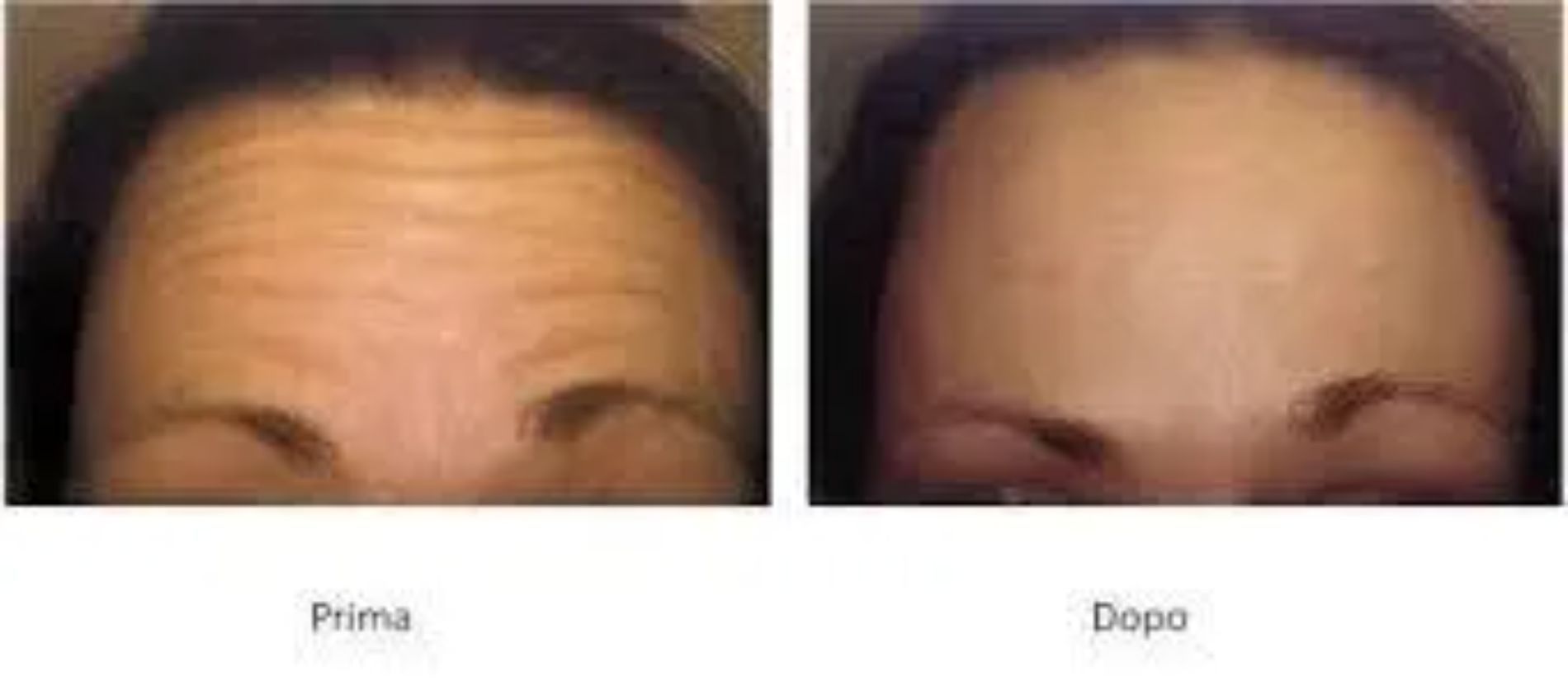 riduzione rughe post trattamento