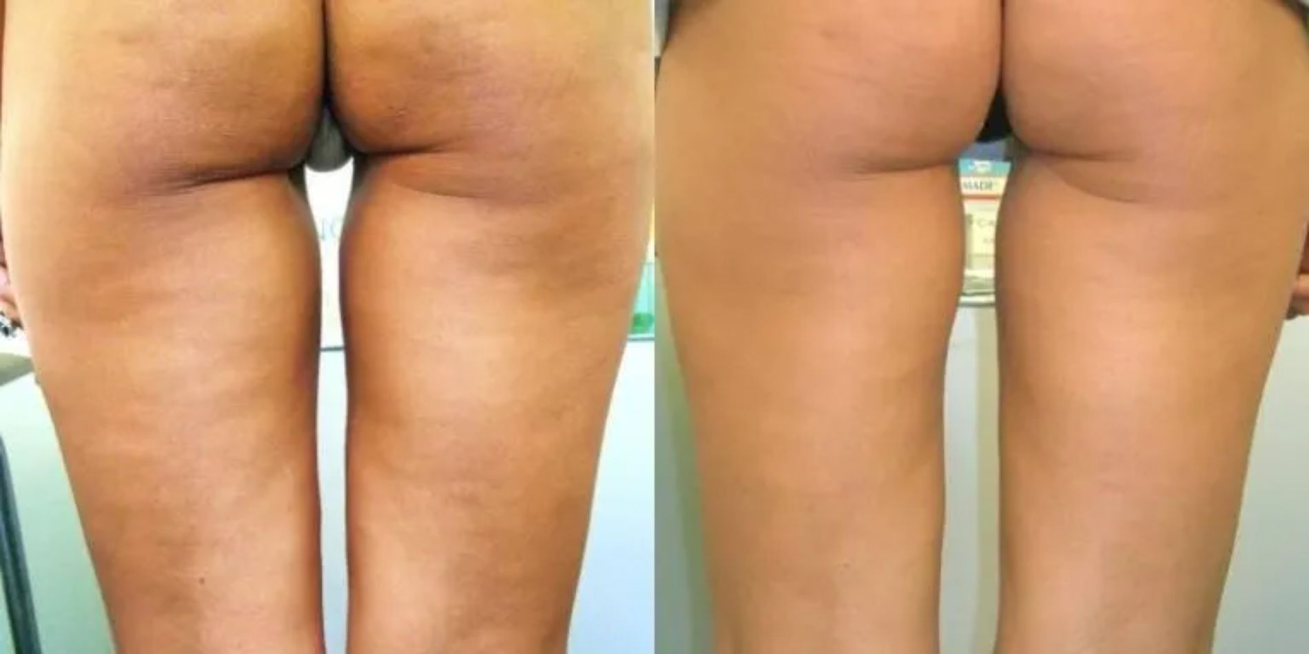 trattamento per culotte de cheval