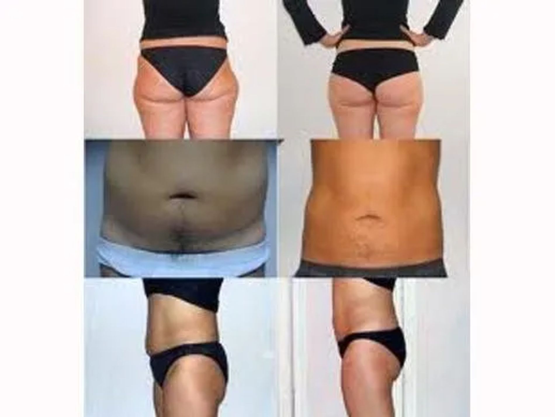 prima e dopo liposuzione