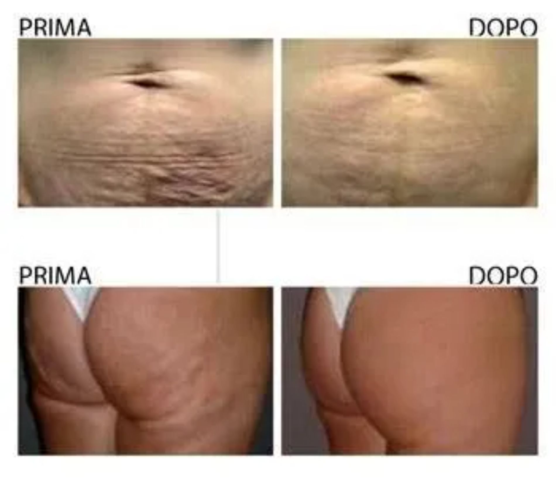 prima e dopo riduzione buccia d'arancia