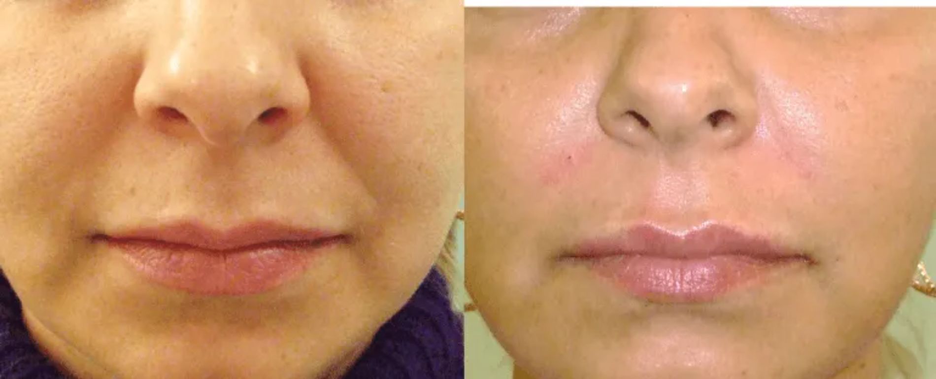 prima e dopo riduzione delle rughe