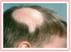 As they age, women lose their hair, tooWhich treatments really work?