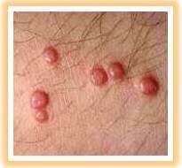 Warts i got genital Genital Warts: