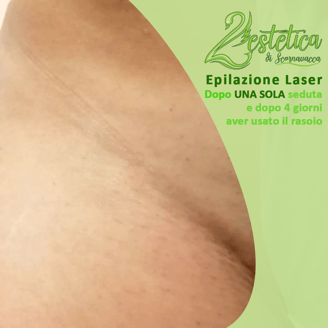 epilazione laser inguine