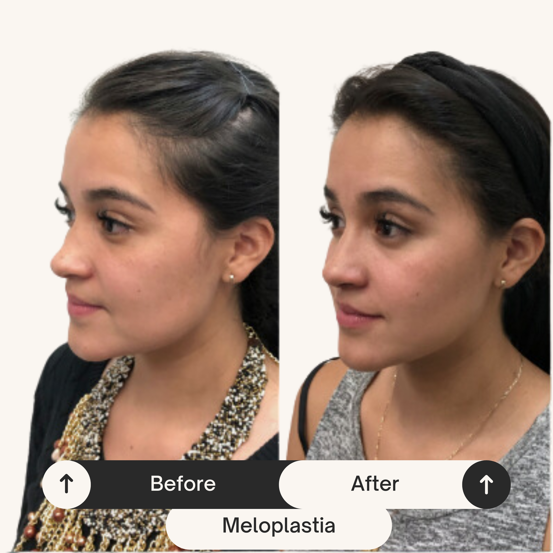 DR. JULIO CASTILLO - RINOPLASTIA CERRADA