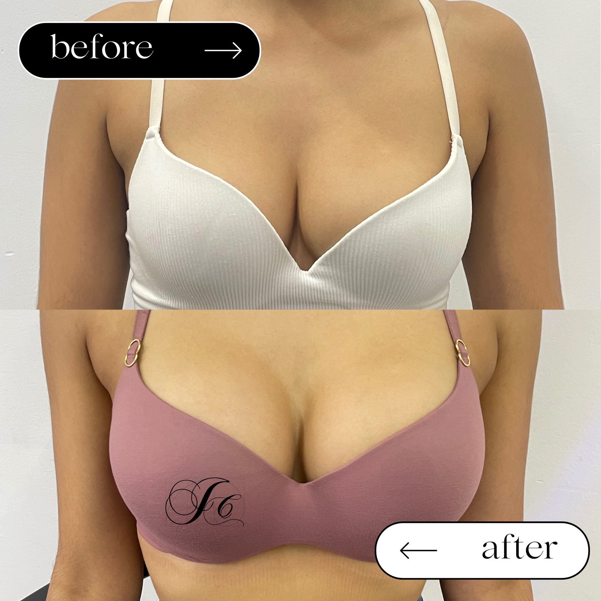 DR. JULIO CASTILLO - LEVANTA LOS SENOS CAÍDOS