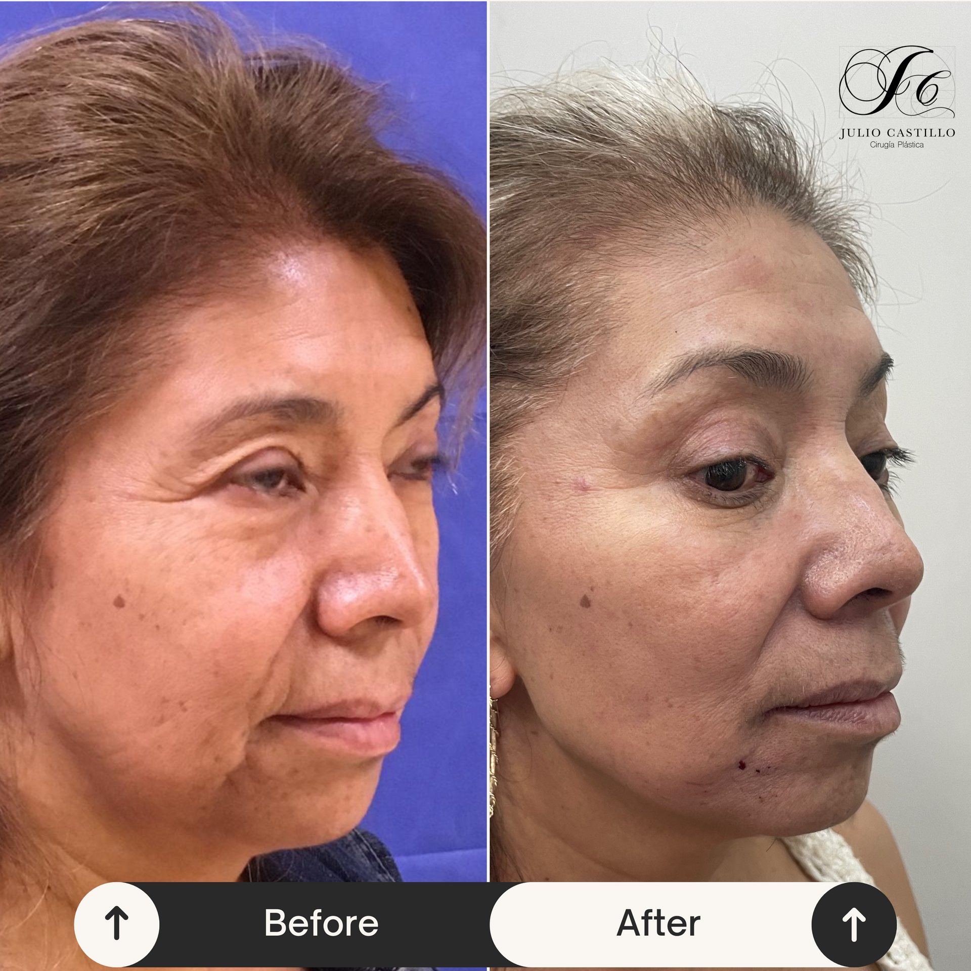 DR. JULIO CASTILLO - RITIDECTOMÍA