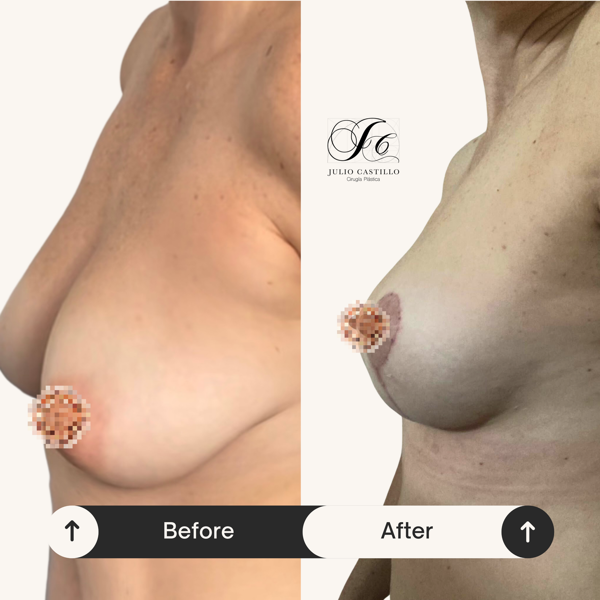 DR. JULIO CASTILLO - IMPLANTES MAMARIOS