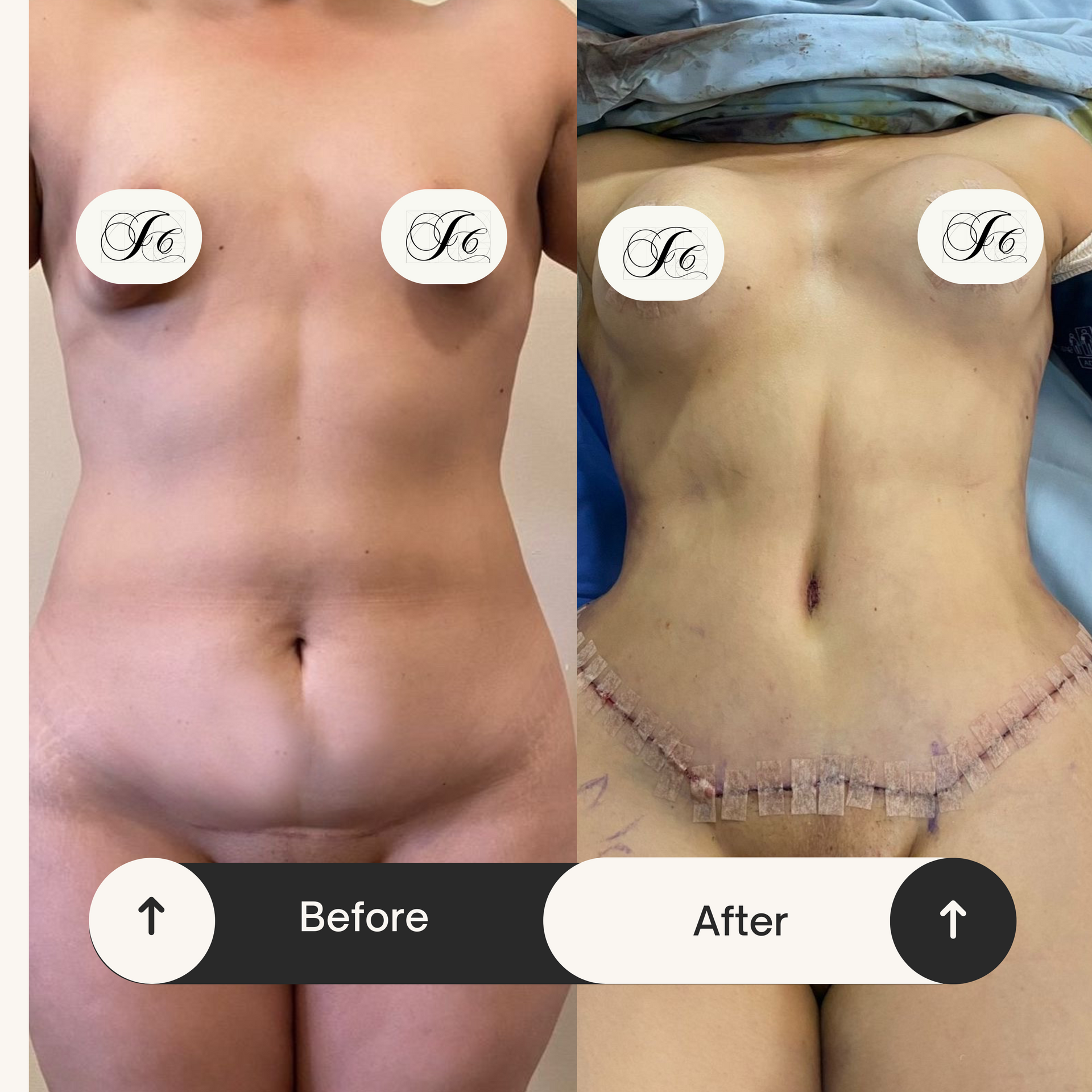 DR. JULIO CASTILLO - LIPOSUCCIÓN