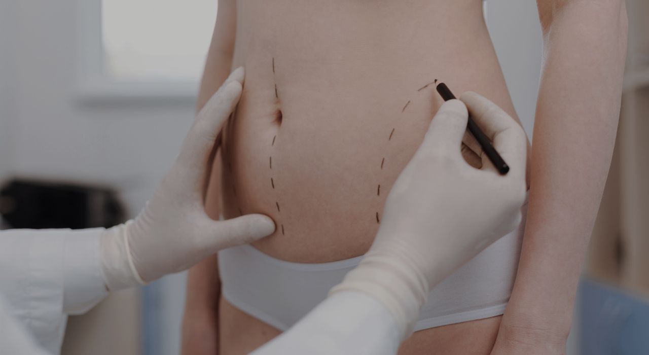 DR. JULIO CASTILLO - TÉCNICAS DE LIPOSUCCIÓN