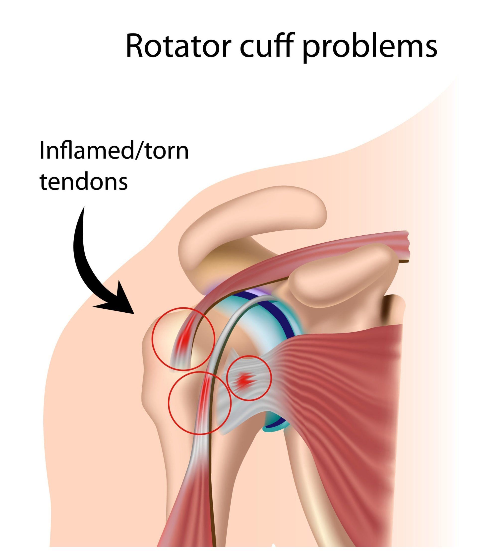 Rotator Cuff Syndrome Massage Therapist Eugene Wood, Located in Wantagh NY 11793, and Massapequa NY 11758