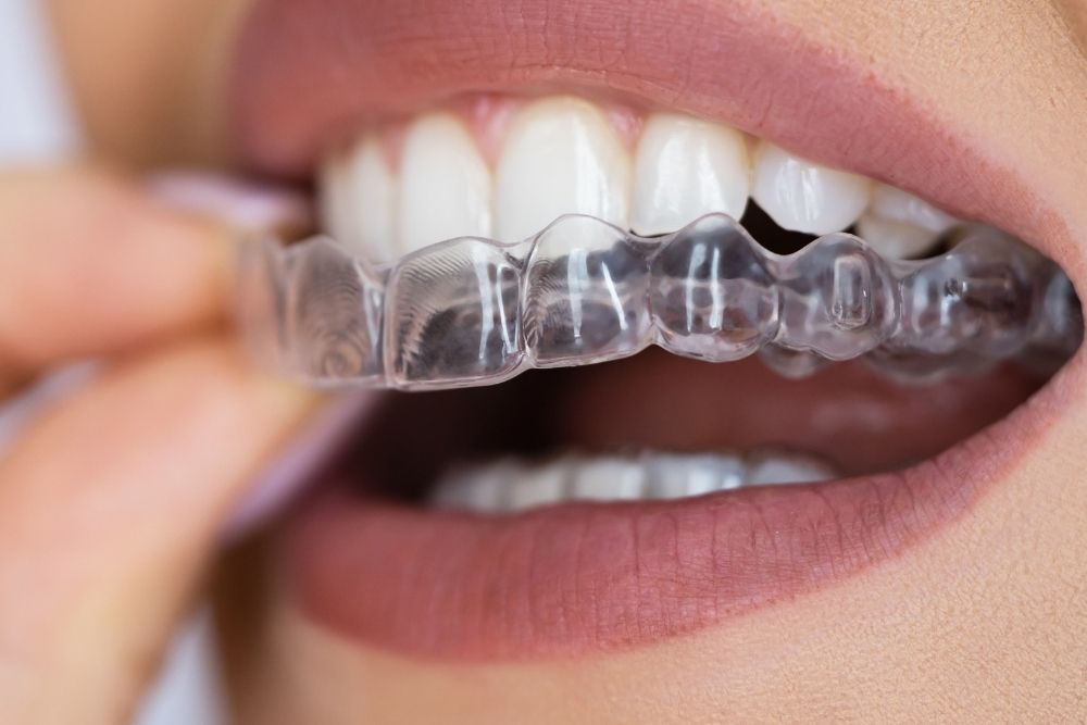 Close-up of a person's mouth inserting a clear aligner over their teeth.