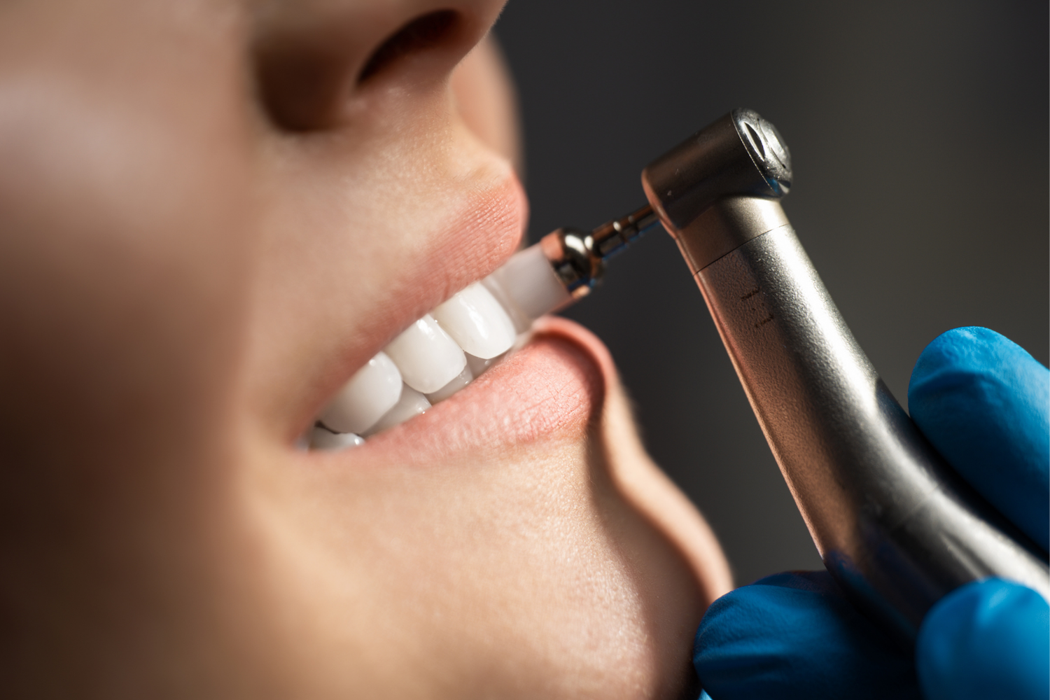 A dental drill polishing a person's teeth, close-up. Blue-gloved hand holds the drill.