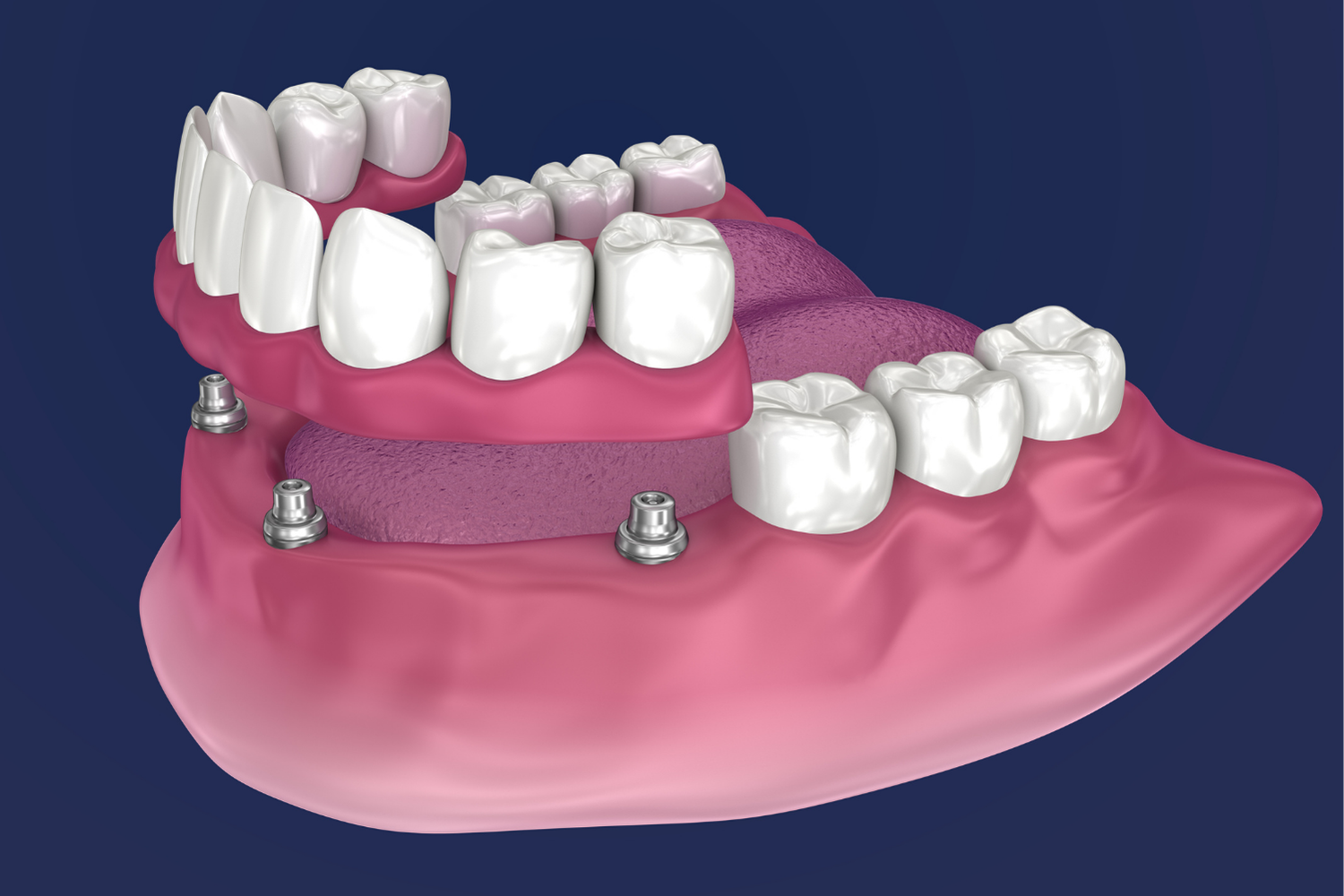 Pink lower denture model with white artificial teeth and metal clasps on a blue background