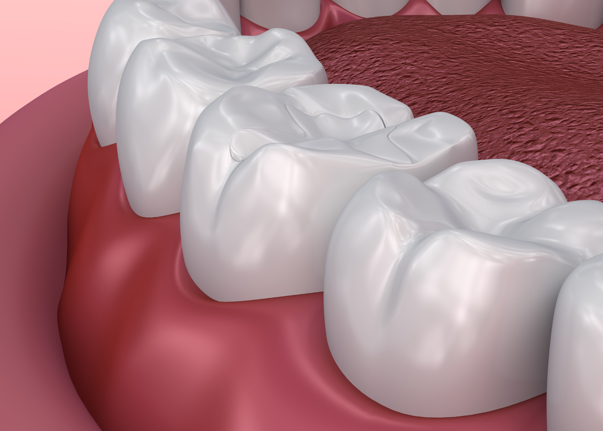 Close-up of white molars and pink gums inside a mouth.