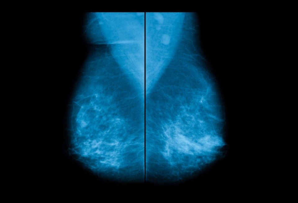 Mammografia seno