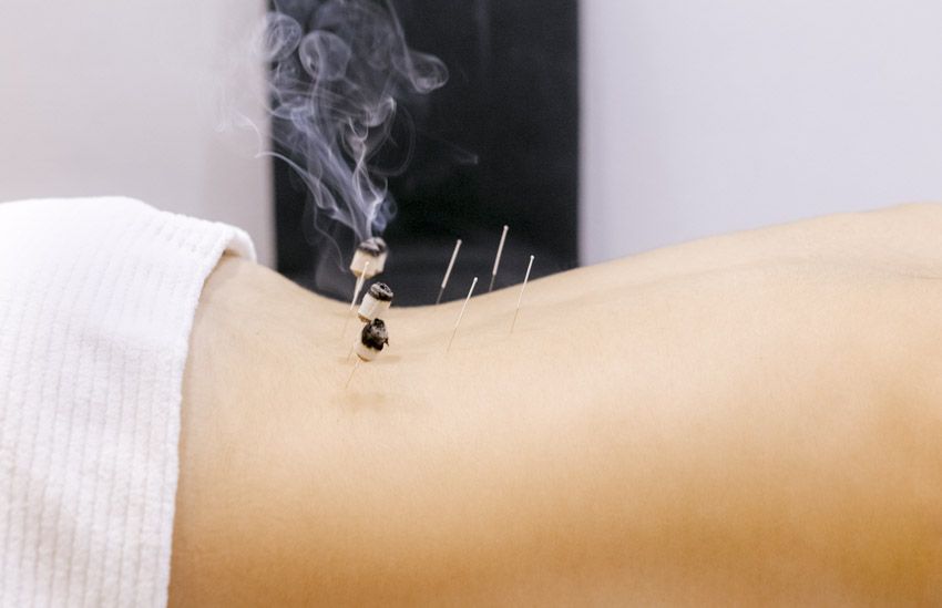 Body receiving moxibustion treatment: lit herbs on acupuncture needles emitting smoke.