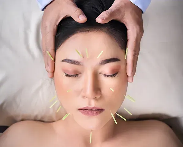 Woman receiving facial acupuncture treatment with needles, practitioner's hands above her face.