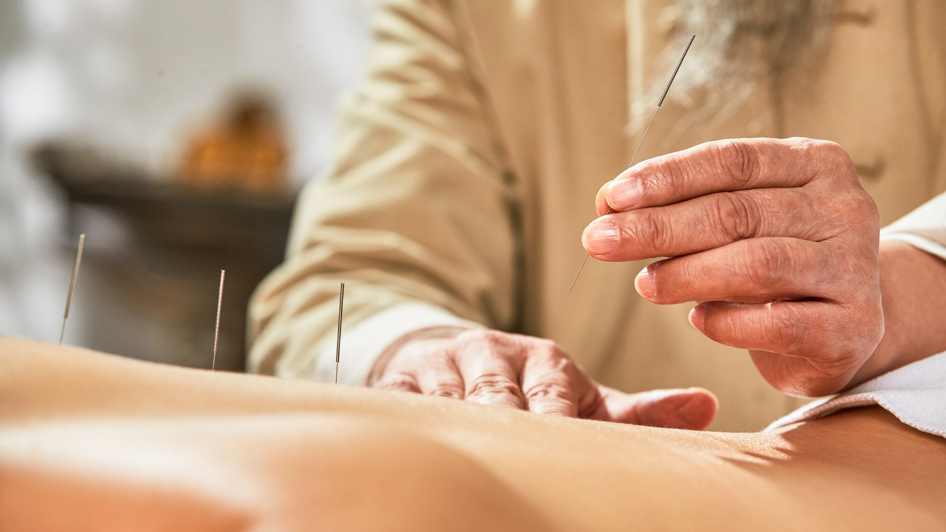 Person performing acupuncture on a patient's back with several needles inserted.