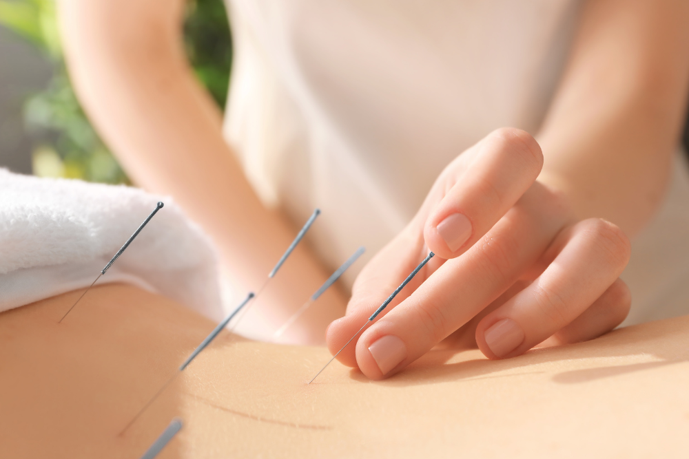 Person receiving acupuncture; needles inserted into back.