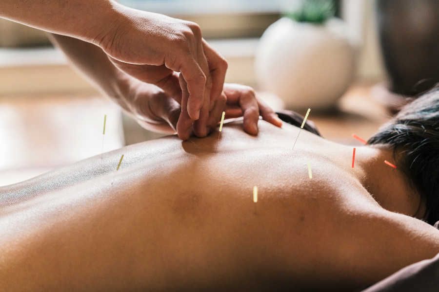 Person receiving acupuncture treatment on their back, needles inserted, indoors.