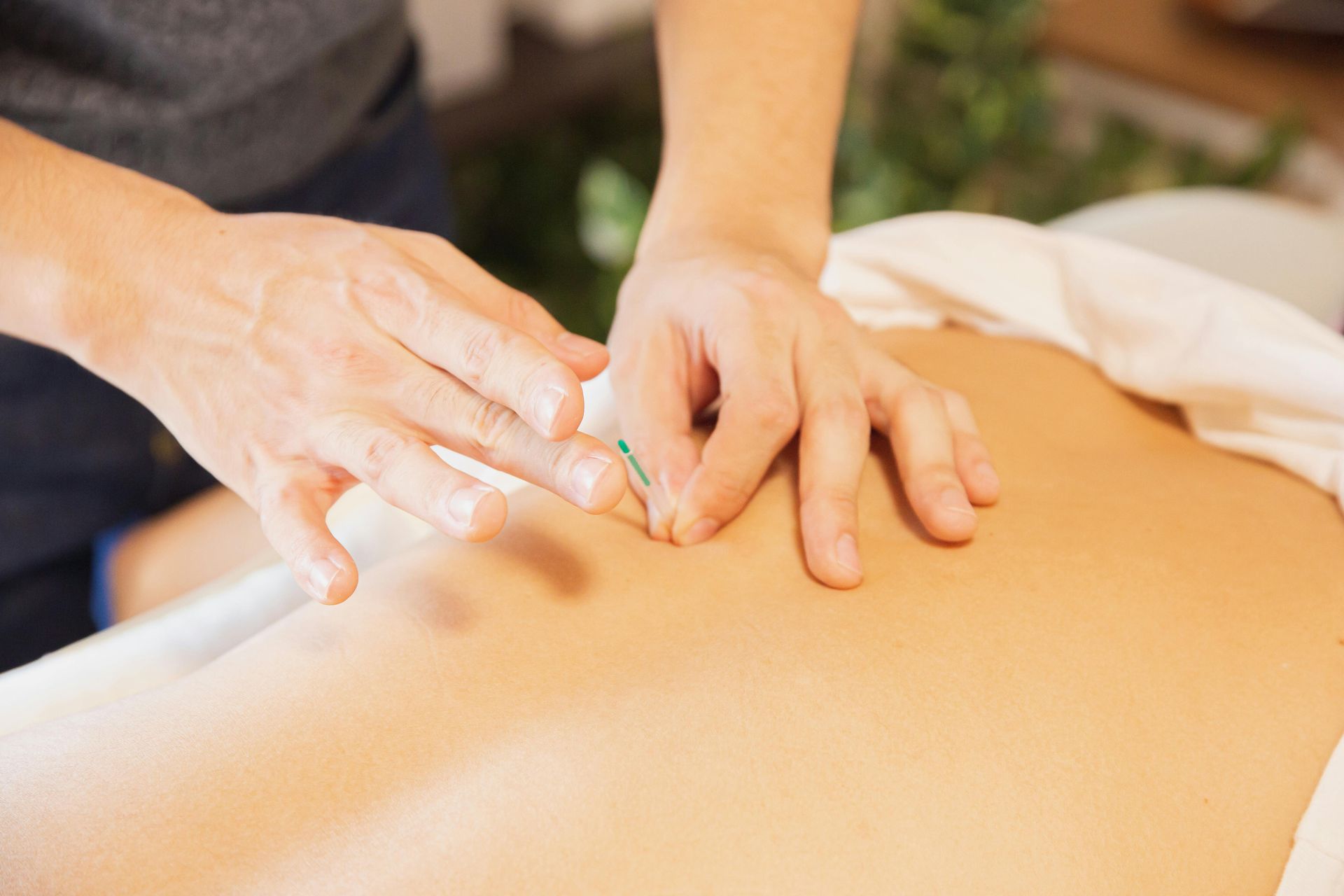 Hands inserting acupuncture needles into a person's back.
