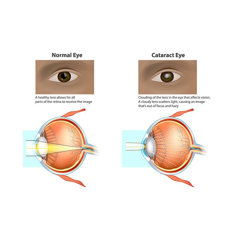Surgery — Illustration of a Normal Eye and an Eye with a Cataract in Tucson, AZ