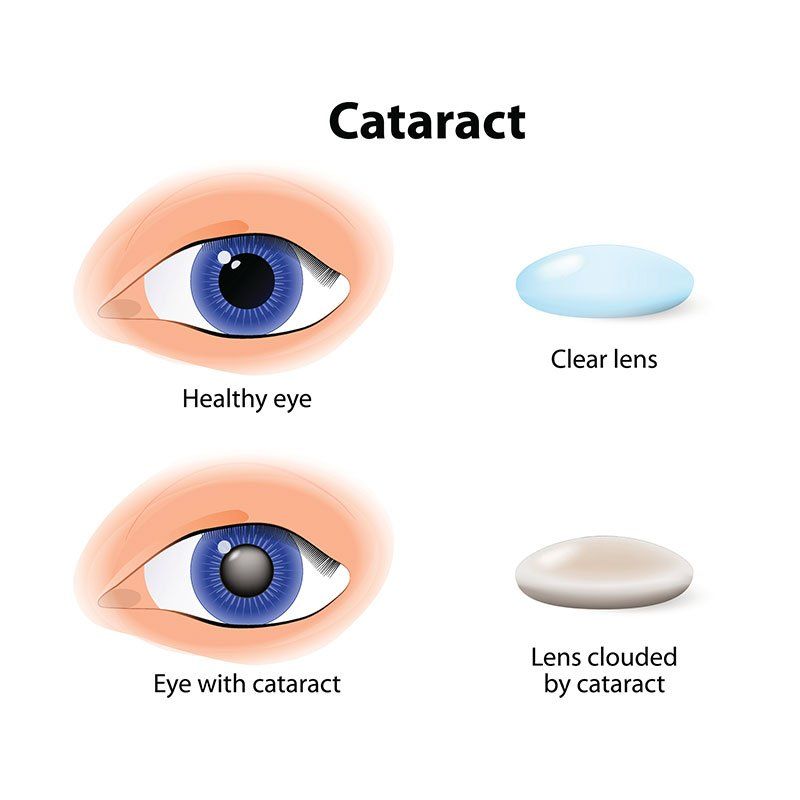 Cataracts — Cataract is an Clouding Crystalline Lens in Tucson, AZ