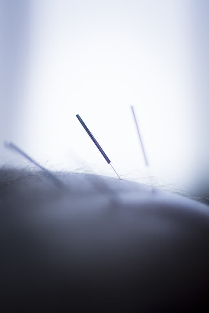 Dry Needling Acupunture - Massage Therapy in Grafton, NSW