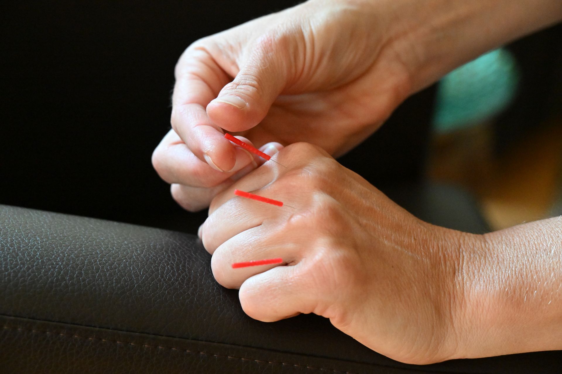Acupuncture needles between the knuckle joints on a person's left hand.