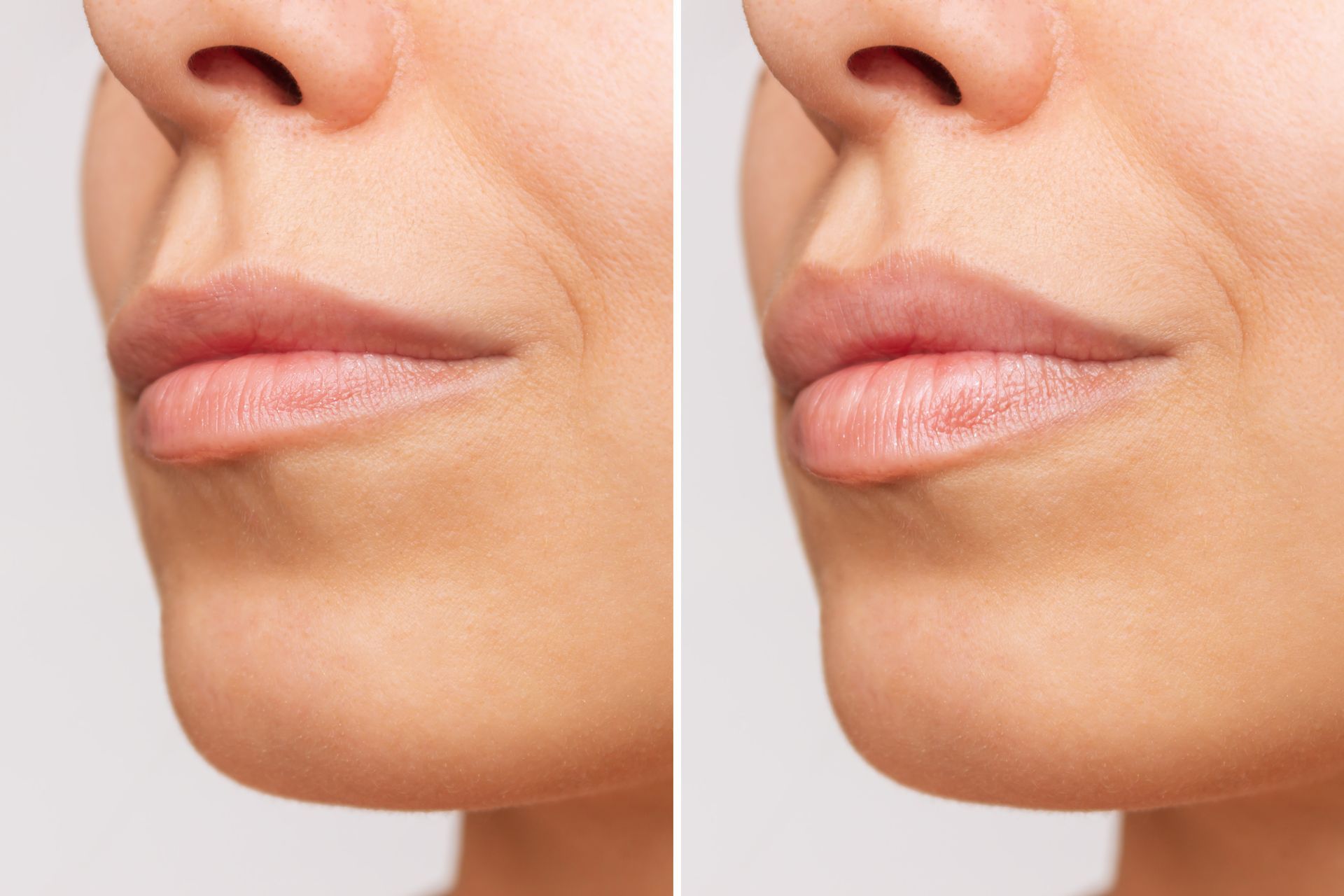 medicina estetica periorale - filler labbra