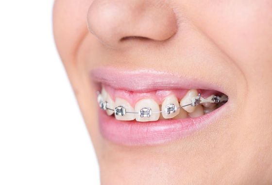 ortodonzia, apparecchi ortodontici fissi