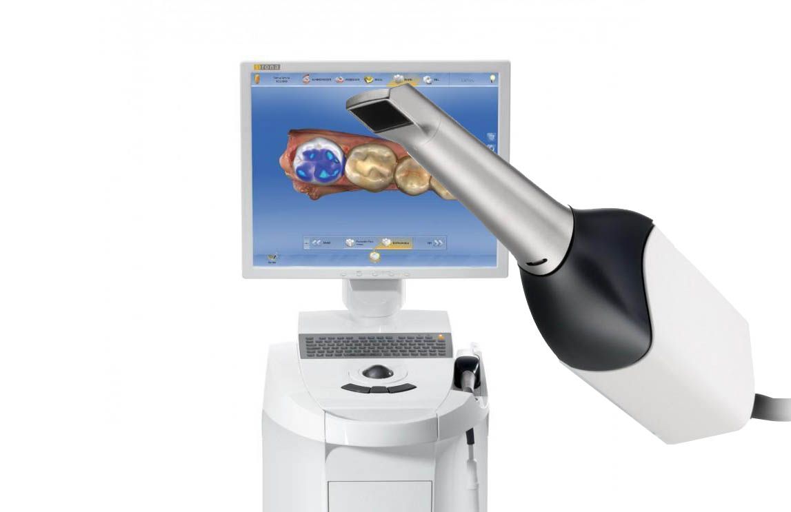 Scanner Intraorale - impronta digitale dentale