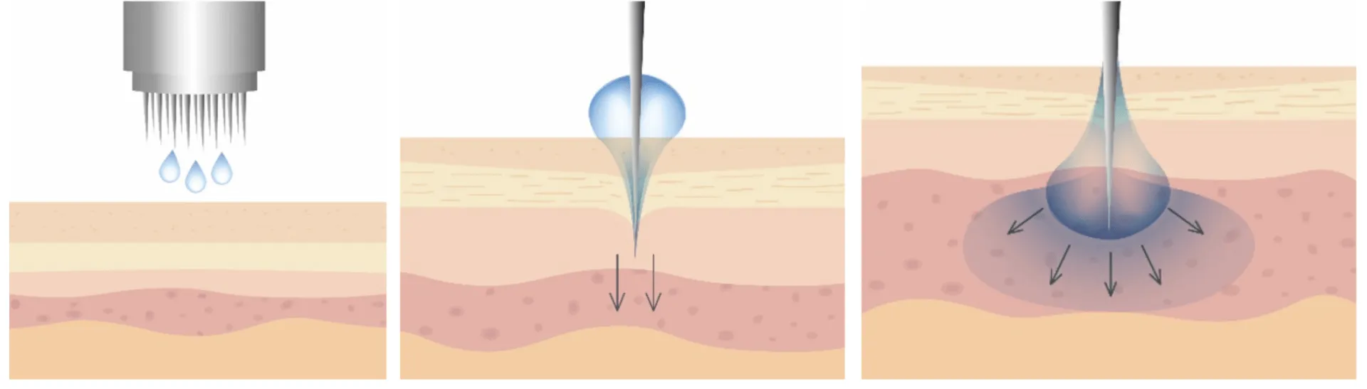 medicina estetica periorale - microneeding