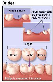 dental bridge porcelain zz f