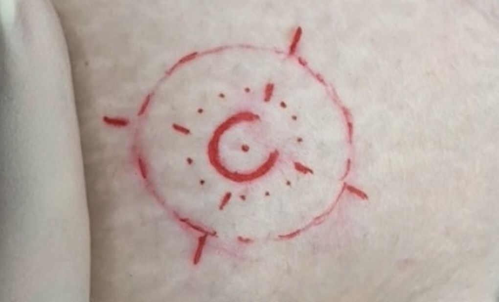 A close up of a person 's arm with a red circle with a letter c in it — Sibina Cosmetic Tattoo Art In Broadbeach, QLD