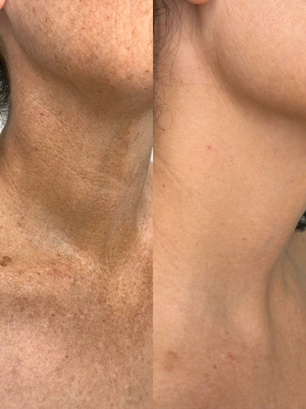 A close up of a person 's hand with a rash on it — Sibina Cosmetic Tattoo Art In Broadbeach, QLD