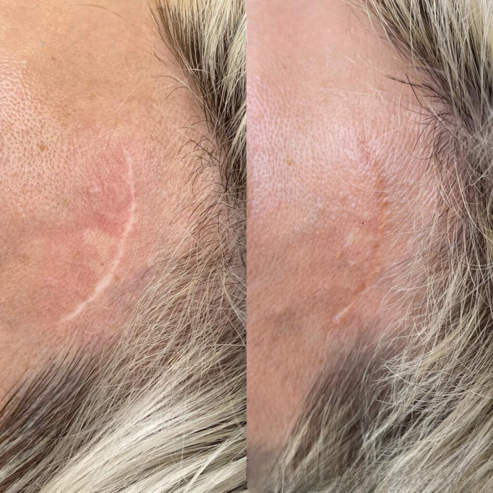 A before and after photo of a woman 's face with a scar on it — Sibina Cosmetic Tattoo Art In Broadbeach, QLD