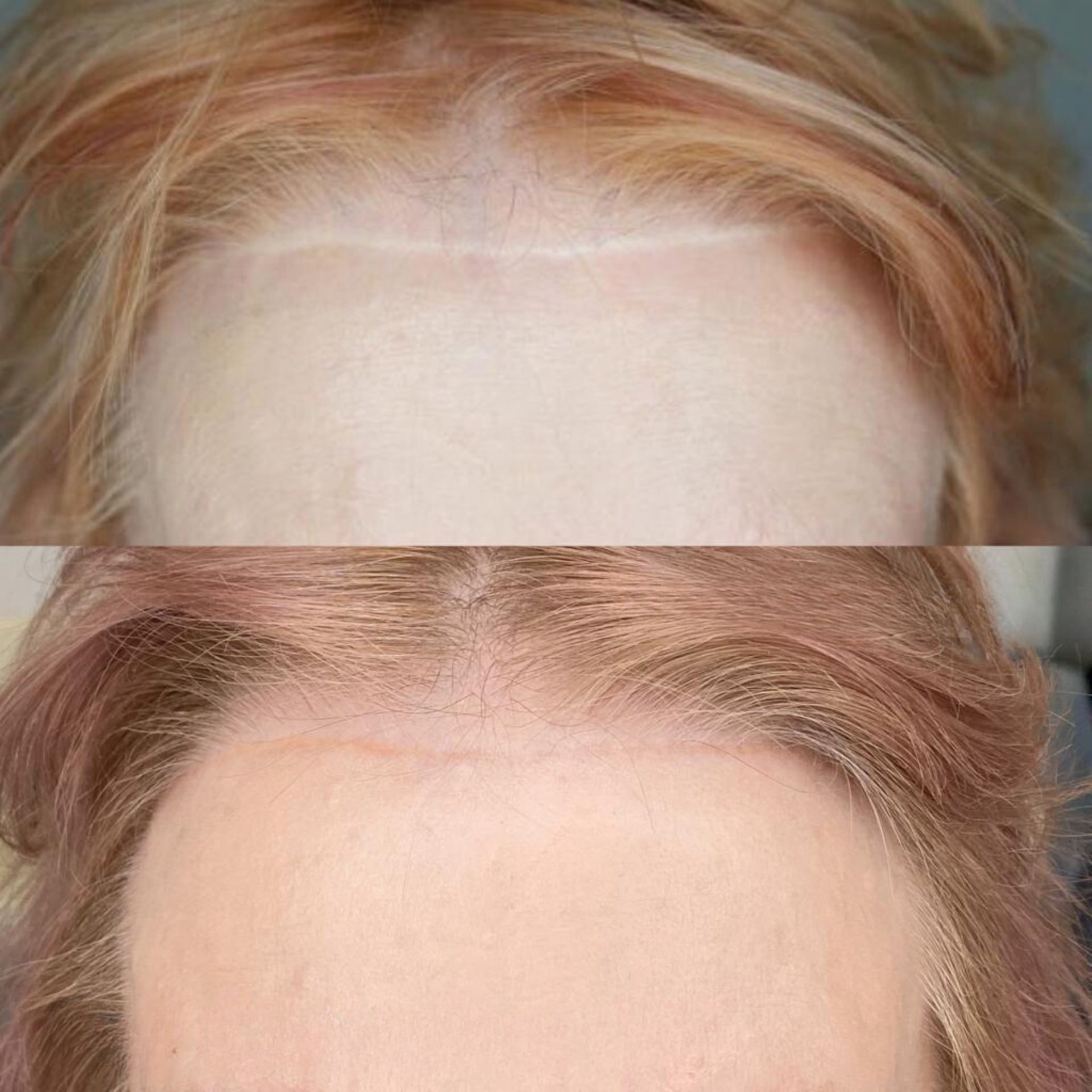 A before and after photo of a woman 's forehead — Sibina Cosmetic Tattoo Art In Broadbeach, QLD