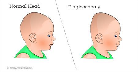 plagiocephaly, pediatric chiropractor