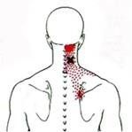 Back view of a person with highlighted areas of pain in the neck and shoulder, indicated by red and black markings.