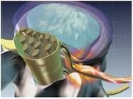 Illustration of a spinal disc with a close-up of the disc's fibrous outer layer and gel-like inner core.