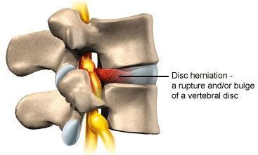 Diagram of a spine showing a herniated disc, with a red bulge, and a label: 