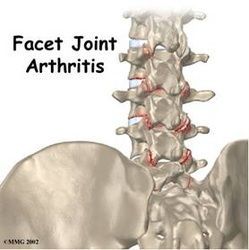 Illustration of spine showing facet joint arthritis, marked with red.